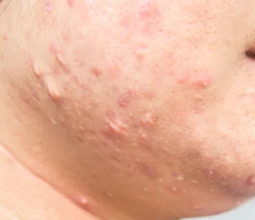 Laser Scar Reduction